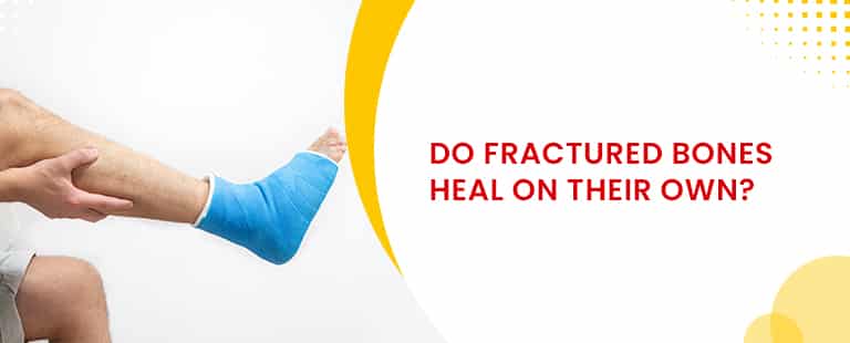 Do fractured bones heal on their own?